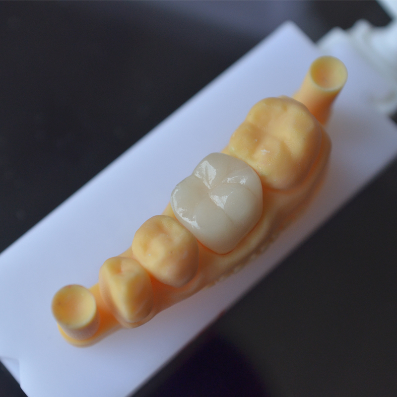 3D Printing Ng Pustiso