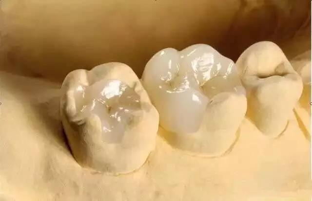 Zirconia Dental Inlay para sa Salvage Maliit na Surface Defect ng Nature Tooth
