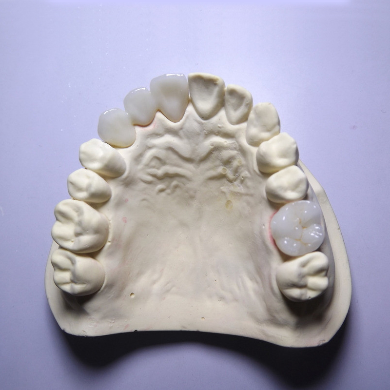 Bakit ang zirconia crown ay may mataas na kalidad