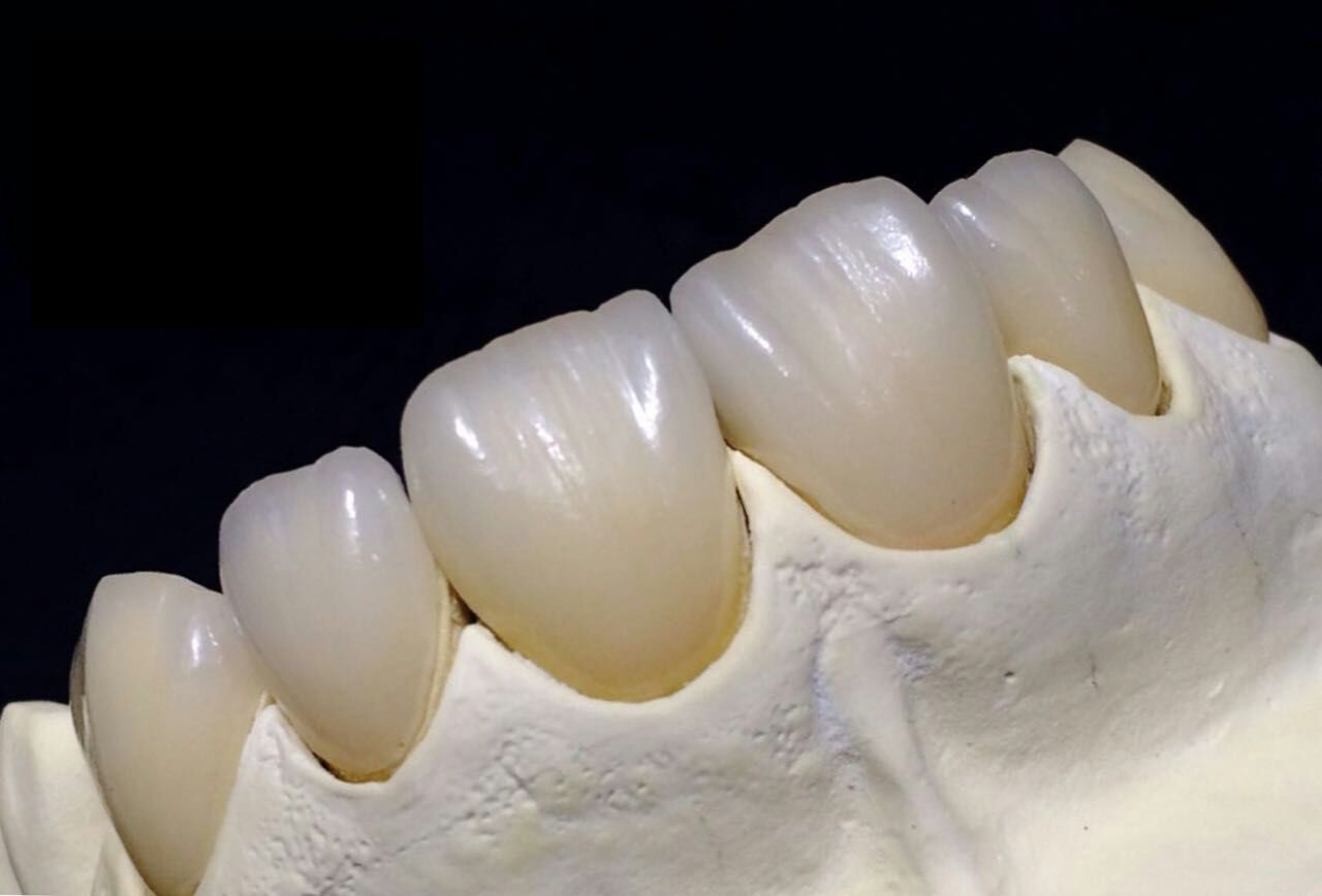Mga pag-iingat tungkol sa zirconia porcelain na ngipin
