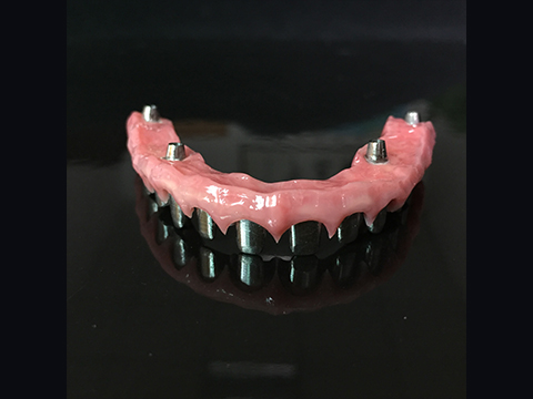 Ano ang dapat nating gawin pagkatapos ng dental implant?