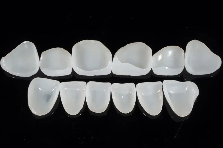 Ano ang mga pakinabang ng dental veneer?