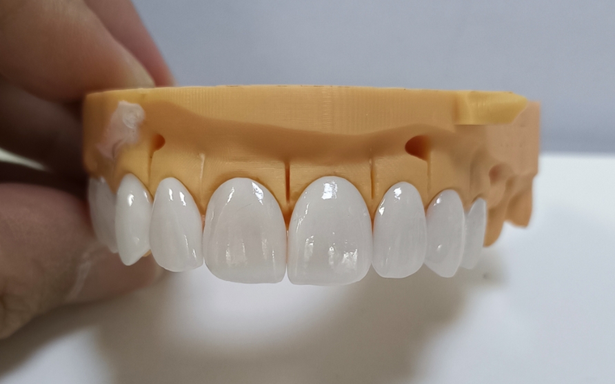 Mga High Esthetic na Emax Veneer
