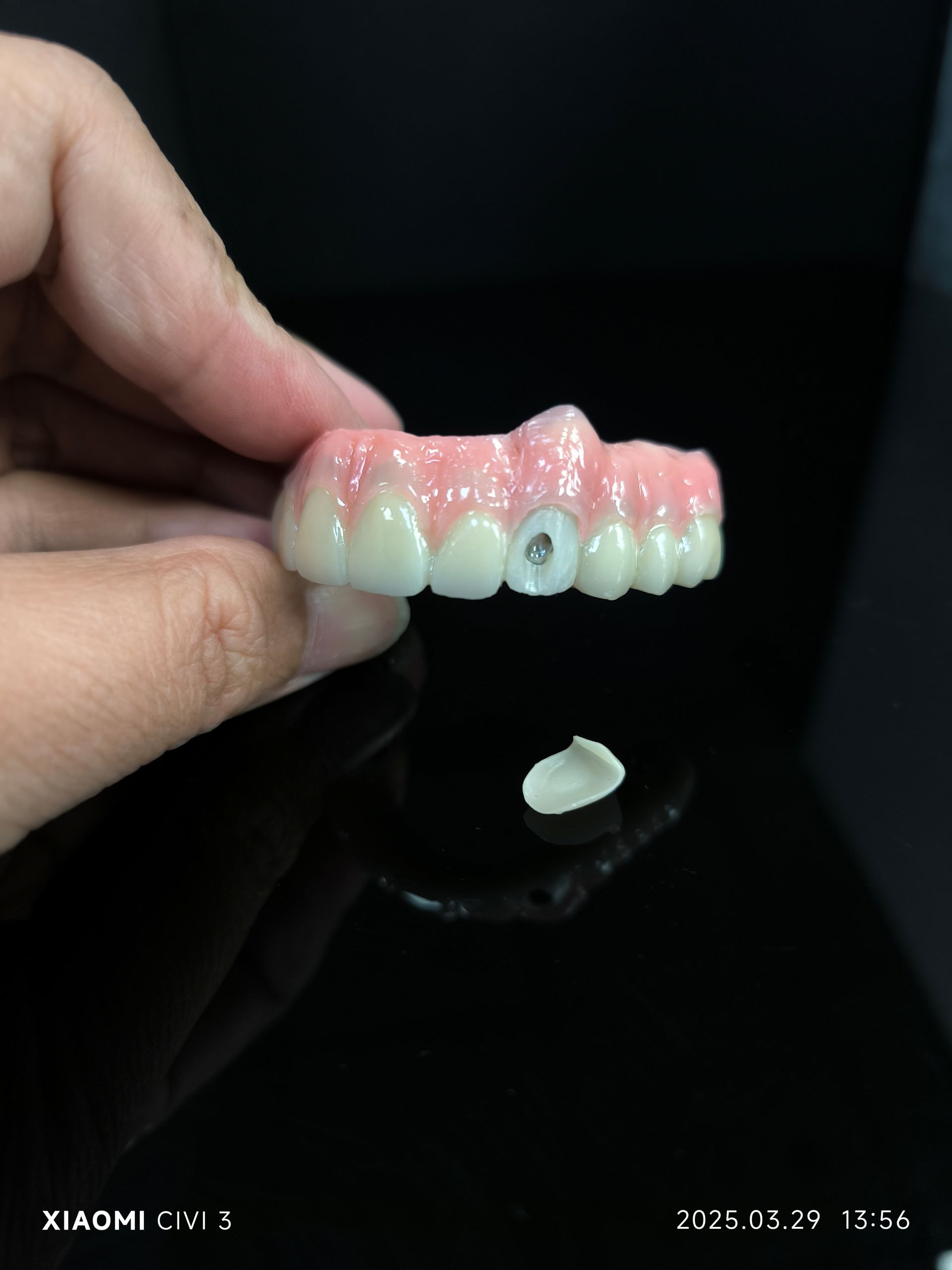 Lahat sa 4 na Hybrid - Hybrid Zirconia Bridge Solution para sa Vestibular Screw Hole