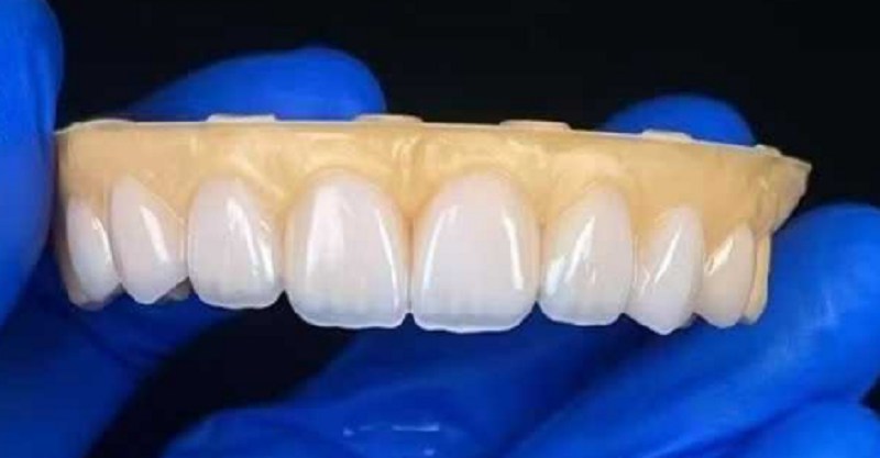 Mga veneer ng ngipin upang ayusin ang problema ng labis na mga gaps ng ngipin