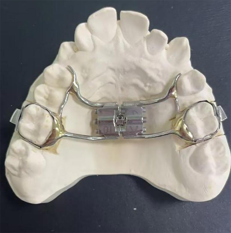 Ano ang isang mabilis na maxillary expander (RME)?