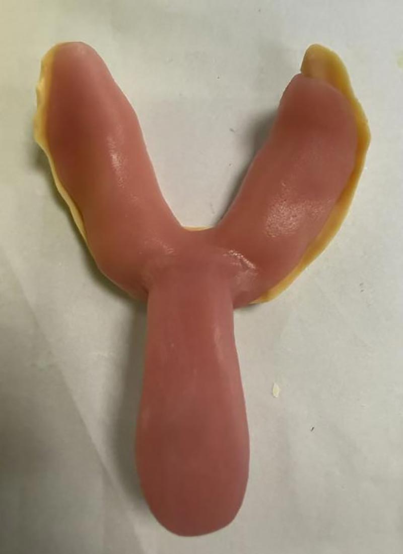 Mga Bagay na Hindi Mo Alam Tungkol sa Mga Custom na Dental Tray