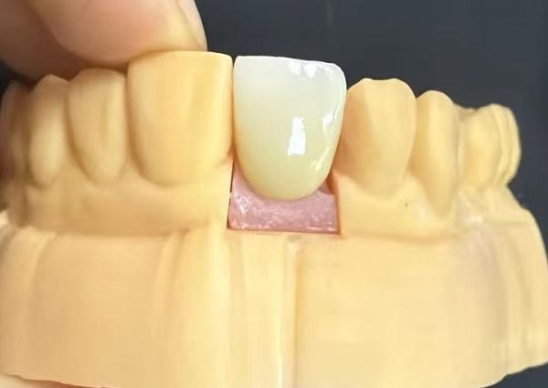 Maaaring Ayusin ang Mga Puwang sa Pagitan ng Ngipin—Ang Tuwid na Ngipin ang Pinaka Kaakit-akit!