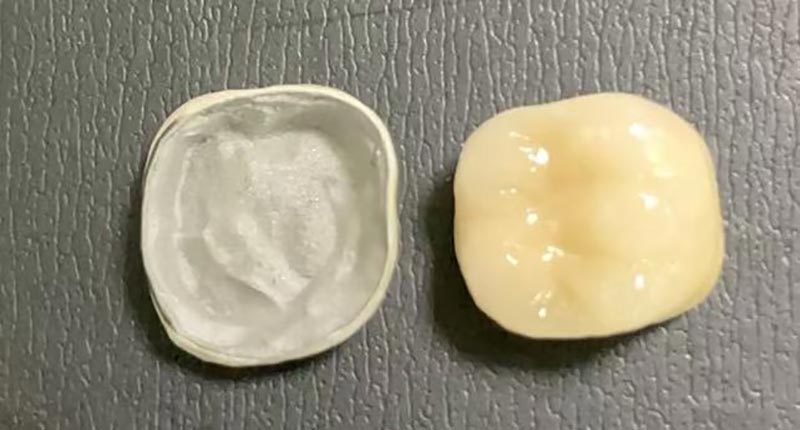 Ano ang Gagawin Kapag Ang Iyong Porcelain Crown Chips? Narito Kung Bakit Ito Nangyayari at Paano Ito Aayusin