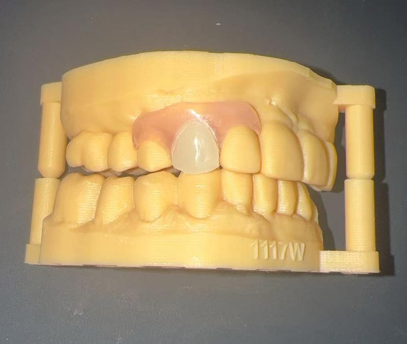 Flexible Partial Denture: Ang Aesthetic at Kumportableng Restoration ng Chinese Dental Lab at WM Dental Lab