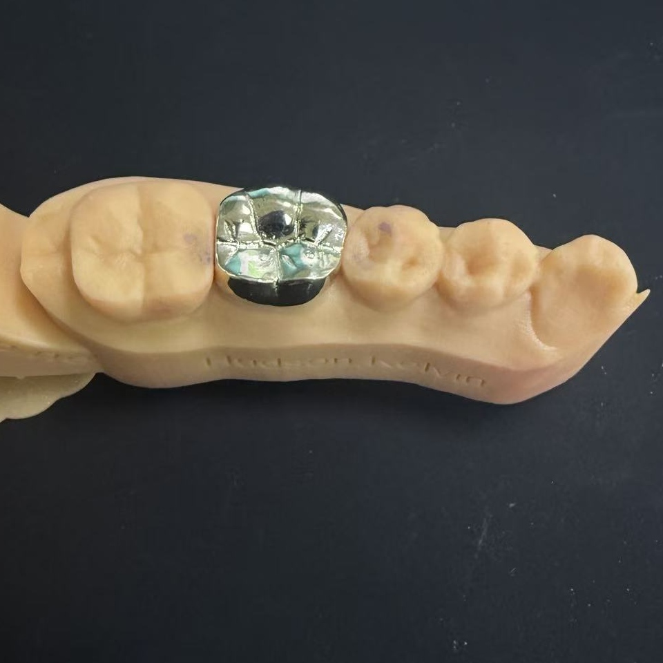 Gold Crowns: Ang Precious Metal Choice para sa Panghabambuhay na Dental Restoration