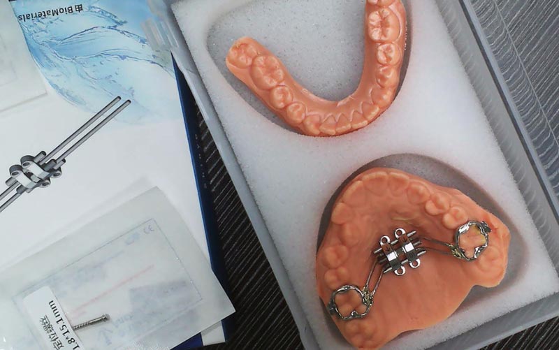 Unawain ang MSE Skeletal Expansion sa WM Dental Lab