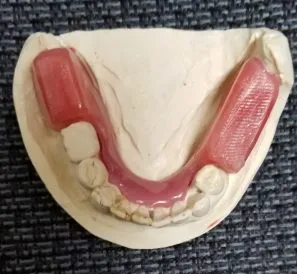 Clinical Guide to Denture Occlusal Rims: Function, VDO, at Step-by-Step na Application
