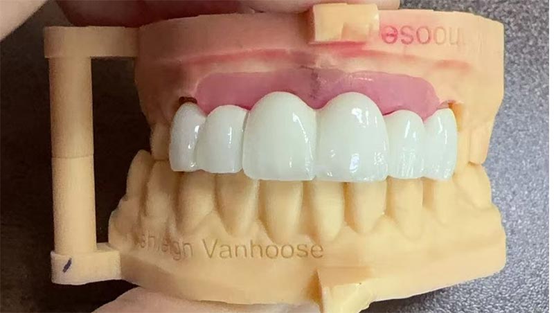 Black Triangles sa Orthodontic Treatment