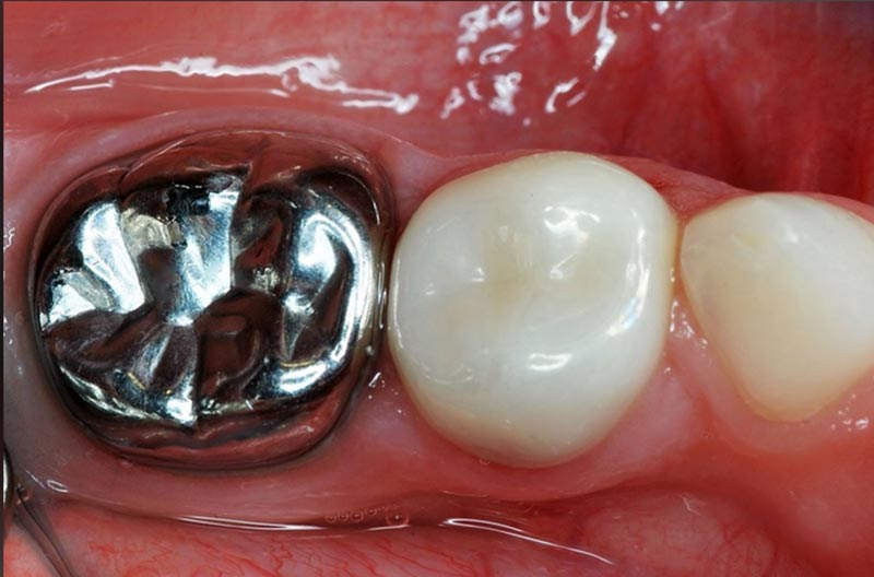 Full-Cast Metal Crowns at Bridges para sa Posterior Restoration