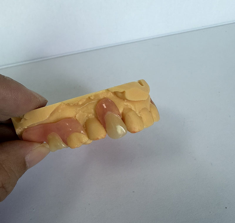 Mga Partial ng Valplast sa WM Dental Lab