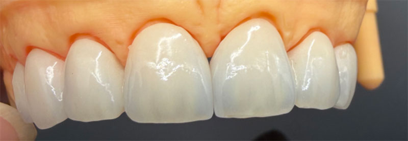 Epekto ng Non-Vital Teeth sa All-Ceramic Crowns at Kaukulang Paggamot