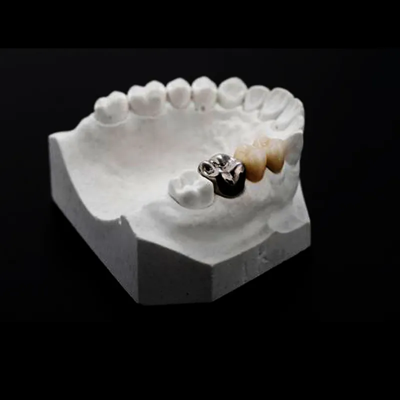 Kailan Dapat Pumili ang mga Clinician ng Full Metal Crown para sa Posterior Restoration?