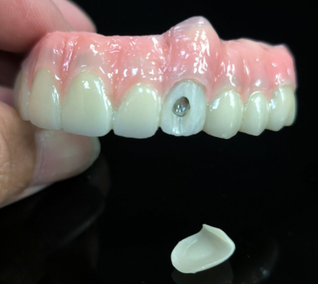 Lahat sa 4 na Hybrid - Hybrid Zirconia Bridge Solution para sa Vestibular Screw Hole
