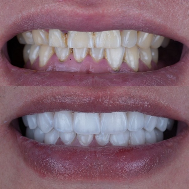 Emax Layered Veneers Esthetic China Dental Lab trabaho