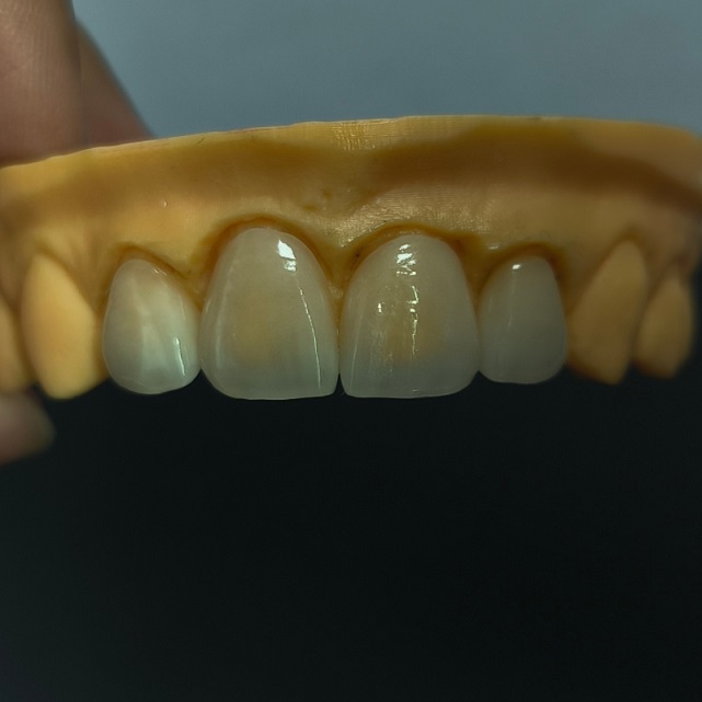 High Translucent Dental Veneer Layered Emax Veneer