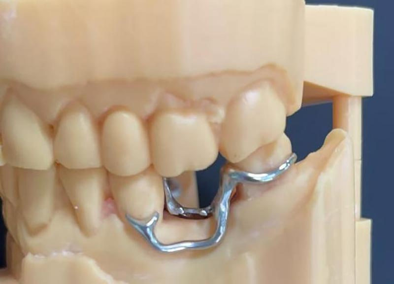 Cobalt-Chromium Framework Try-in