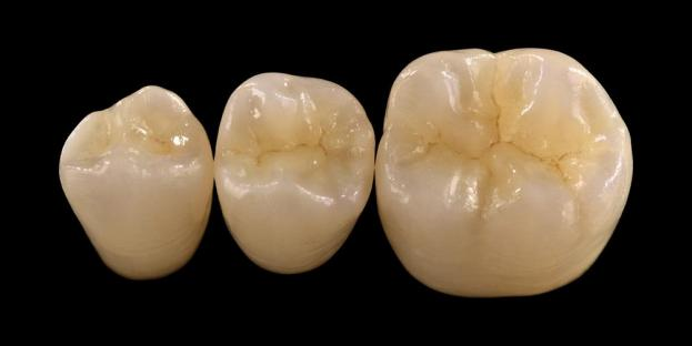 <h2>Zirconia sa Dentistry: Mga Indikasyon, Mga Bentahe, at Klinikal na Pagsasaalang-alang</h2>
<p>Ang Zirconia ay malawak na kinikilala para sa lakas at tibay nito. Ang pinakabagong mga henerasyon ng mga materyales ng zirconia ay nag-aalok din ng makabuluhang pinabuting mga katangian ng aesthetic. Para sa mga pasyente na isinasaalang-alang ang lahat-ng-ceramic na pagpapanumbalik, mahalagang maingat na suriin ang parehong mga indikasyon at limitasyon ng mga sistemang nakabatay sa zirconia.</p>
<p>Ang mga pasyente ngayon ay lalong umaasa ng mga pagpapanumbalik na pinagsasama ang mahusay na aesthetics na may ganap na pagganap na pagganap. Karamihan sa mga modernong ceramic system ay maaaring matugunan ang mga inaasahan, ngunit ang klinikal na tagumpay ay higit na nakasalalay sa tamang pagpili ng materyal, paghahanda ng ngipin, at mga protocol ng sementasyon. Ang pagpili ay dapat na ginagabayan ng mga pangunahing katangian ng materyal tulad ng paglaban sa bali, lakas ng flexural, resistensya ng pagsusuot, at pangmatagalang katatagan. Kabilang sa mga materyales na ito, ang zirconia ay naging isa sa mga pinaka-tinatanggap na ginagamit na mga opsyon sa kontemporaryong restorative dentistry.</p>
<h3>Bakit Pumili ng Zirconia?</h3>
<p>Ang Zirconia ay pinahahalagahan para sa pambihirang lakas at pangmatagalang tibay nito. Ang modernong zirconia ay makabuluhang naiiba mula sa mga naunang henerasyon, na mas malabo at hindi gaanong aesthetic. Ngayon, ang teknolohiya ng CAD/CAM ay nagbibigay-daan sa tumpak na paggawa ng mga zirconia restoration na may pinahusay na optical properties.</p>
<p>Maaaring idisenyo ang mga pagpapanumbalik bilang:</p>
<ul>
<li><strong>Monolithic zirconia:</strong>Tamang-tama para sa posterior na mga korona at tulay, na nag-aalok ng mataas na lakas at tibay.</li>
<li><strong>Layered zirconia:</strong>Angkop para sa mga kaso na nangangailangan ng pinahusay na aesthetics, kabilang ang mahabang-span na pagpapanumbalik sa iba't ibang bahagi ng bibig.</li>
</ul>
<p>Ang lakas ng flexural ay nag-iiba depende sa uri, mula sa humigit-kumulang 590 MPa sa high-translucency zirconia hanggang sa 1400 MPa sa mga monolithic form. Maaaring isemento ang mga pagpapanumbalik ng zirconia gamit ang mga self-adhesive resin cement o resin-modified glass ionomer cement.</p>
<h3>Mga Pangunahing Salik sa Pagpili ng Materyal na Zirconia</h3>
<p>Kapag isinasaalang-alang ang zirconia para sa isang all-ceramic restoration, dapat suriin ng mga clinician ang ilang kritikal na salik:</p>
<ul>
<li>Ang natitirang istraktura ng ngipin</li>
<li>Lokasyon sa oral cavity (aesthetic zone vs functional zone)</li>
<li>Pagkakaroon ng mga parafunctional na gawi tulad ng bruxism</li>
<li>Translucency ng katabing natural na ngipin</li>
<li>Kulay at kondisyon ng pinagbabatayan na istraktura ng ngipin</li>
</ul>
<p>Ang aesthetic zone ay kadalasang kinabibilangan ng mga anterior na ngipin, bagaman sa ilang mga pasyente maaari itong umabot sa unang molar depende sa linya ng ngiti at dynamics ng mukha. Ang functional zone sa pangkalahatan ay kinabibilangan ng mga premolar at molar, kung saan ang mga puwersa ng occlusal ay mas mataas.</p>
<h3>Mga Application sa Functional Zone</h3>
<p>Sa mga posterior na rehiyon, ang mga puwersa ng occlusal ay dapat na maingat na isaalang-alang. Ang Zirconia ay isang mahusay na alternatibo sa tradisyonal na mga pagpapanumbalik ng PFM, lalo na sa mga kaso na may limitadong espasyo sa pagpapanumbalik. Pinapayagan ng modernong monolithic zirconia ang full-contour na disenyo ng occlusal anatomy, kabilang ang functional cusps at marginal ridges, habang pinapanatili ang mataas na lakas.</p>
<p>Ang kasalukuyang ebidensya ay nagpapakita na ang monolithic zirconia ay angkop na angkop para sa posterior crowns at multi-unit bridges dahil sa mahusay nitong pagtutol sa bali at pagkasira. Ang mga pag-unlad sa mga diskarte sa pandikit at disenyo ng paghahanda ay nagpabuti din ng mga pangmatagalang klinikal na kinalabasan.</p>
<h3>Mga Aplikasyon ng Aesthetic Zone</h3>
<p>Sa anterior na rehiyon, ang mga pagpapanumbalik ay dapat na malapit na magtiklop ng natural na kulay ng ngipin, translucency, at magaan na pag-uugali. Habang ang mga materyales tulad ng lithium disilicate ay nag-aalok ng mahusay na aesthetics, ang mga ito ay hindi gaanong malakas at karaniwang nangangailangan ng adhesive bonding.</p>
<p>Ang isang pangunahing bentahe ng zirconia ay ang kakayahang maging conventionally cemented habang nakakamit pa rin ang mataas na aesthetic na pagganap. Sa pagbuo ng mga high-translucency at multilayer zirconia system, posible na ngayong gumawa ng mga restoration na malapit na gayahin ang natural na dentition.</p>
<p>Ang mga advanced na diskarte sa pagpoproseso ay higit na nagpapahusay ng mga optical na katangian at binabawasan ang mga imperpeksyon na maaaring makaapekto sa light transmission at hitsura.</p>
<h3>Pinagsamang Lakas at Aesthetics</h3>
<p>Ang mga sistema ng maagang zirconia ay nag-prioritize sa lakas ngunit walang aesthetic na kalidad. Matagumpay na pinagsama ng modernong monolithic zirconia ang parehong lakas at pinahusay na hitsura, na ginagawa itong angkop para sa isang malawak na hanay ng mga klinikal na kaso.</p>
<p>Ito ay partikular na kapaki-pakinabang para sa mga pasyente na may parafunctional na mga gawi o mga nakaraang pagkabigo sa pagpapanumbalik. Ang mga klinikal na pag-aaral ay nagpapahiwatig ng mataas na pagtanggap ng pasyente at mababang rate ng komplikasyon.</p>
<p>Ang mga alalahanin tungkol sa pagsusuot sa magkasalungat na ngipin ay nabawasan gamit ang mga bagong formulation. Ang mataas na pinakintab na mga ibabaw ng zirconia ay nagpapakita ng mababang potensyal na abrasive, at sa ilang mga kaso ay maaaring mas banayad kaysa sa tradisyonal na porcelain-fused-to-metal restoration.</p>
<h3>Zirconia Implants: Umuusbong na Alternatibo</h3>
<p>Habang ang mga implant ng titanium ay nananatiling pamantayang klinikal, ang mga implant ng zirconia ay nakakakuha ng pansin bilang isang alternatibong walang metal. Pangunahing mga one-piece system ang mga naunang disenyo, ngunit ang two-piece zirconia implants ay nagbibigay-daan na ngayon para sa pinahusay na prosthetic flexibility.</p>
<p>Ang mga implant ng Zirconia ay partikular na kapaki-pakinabang sa mga kaso kung saan umiiral ang mga aesthetic na alalahanin, tulad ng potensyal na kulay abong pagkawalan ng kulay ng mga peri-implant tissue o manipis na gingival biotype. Maaari din silang isaalang-alang para sa mga pasyente na may bihirang titanium sensitivity.</p>
<p>Gayunpaman, ang mga implant ng zirconia ay medyo bago pa rin, at ang pangmatagalang data ng klinikal ay nananatiling limitado kumpara sa mga sistema ng titanium.</p>
<h3>Konklusyon</h3>
<p>Ang Zirconia ay naging isang napakaraming gamit na materyal sa restorative dentistry, na nag-aalok ng isang malakas na balanse sa pagitan ng mekanikal na pagganap at aesthetics. Ang tamang pagpili ng kaso at pagsunod sa mga klinikal na protocol ay mahalaga para sa pagkamit ng pinakamainam na resulta sa parehong anterior at posterior application.</p>